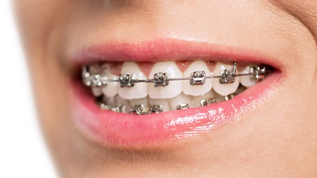 брекеты | Braces