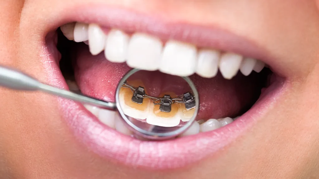 The Secret Power of Orthodontics: Lingual Braces (Hidden Braces) | Ортодонтии