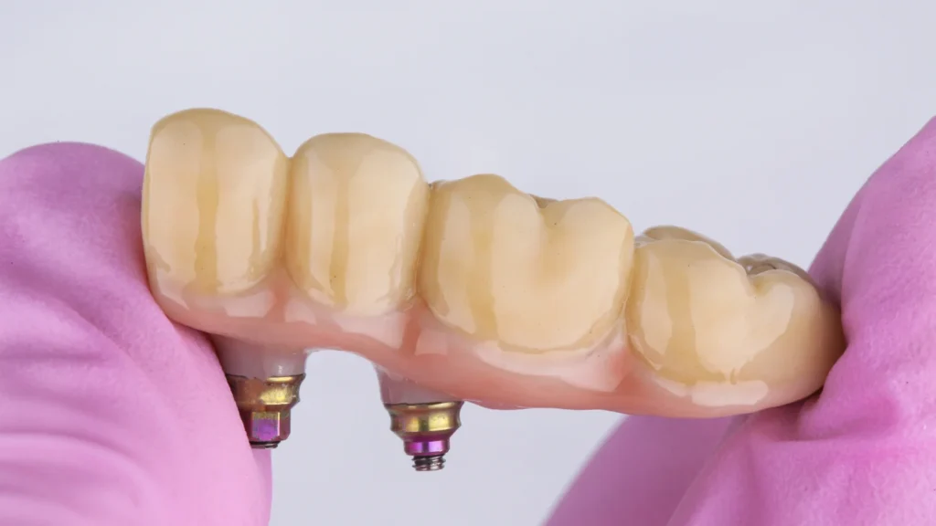 Dental Bridges