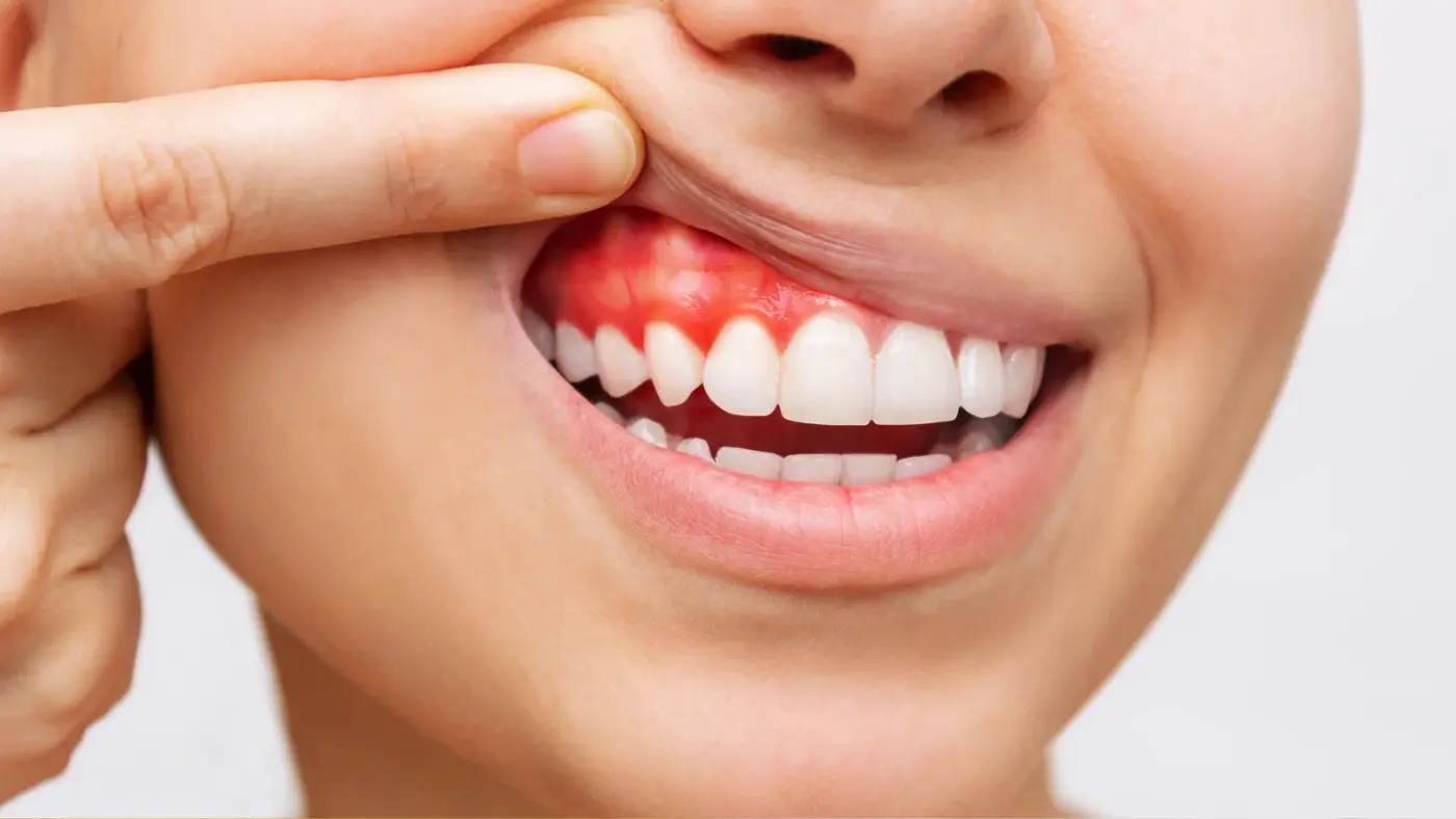 How to Identify Early Signs of Gum Disease