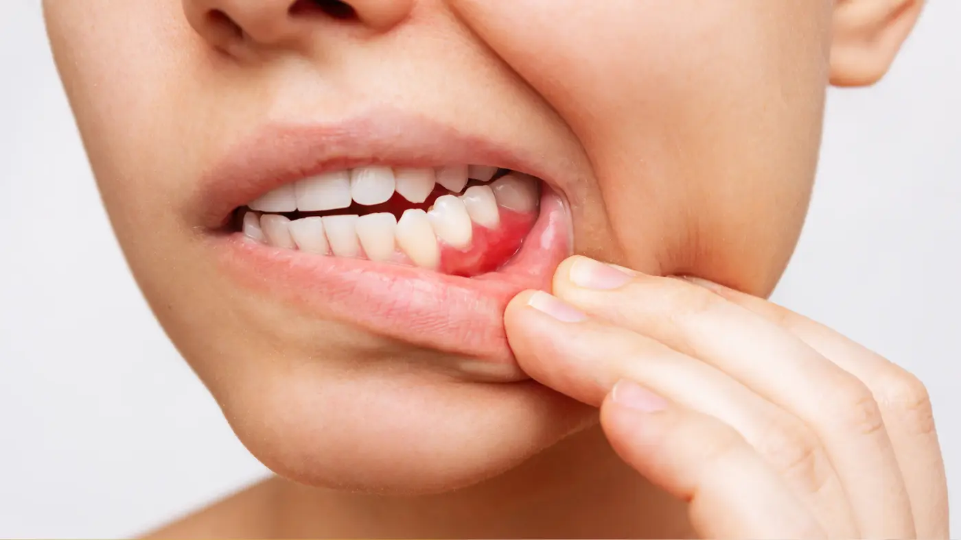 bleeding gum