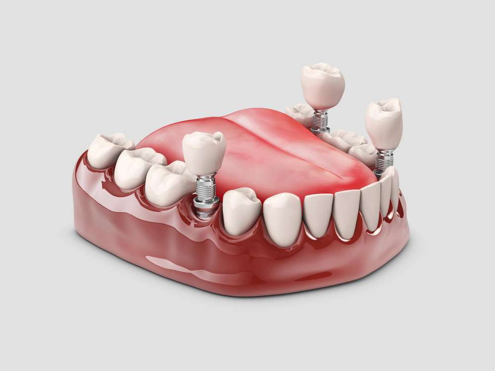 Dental Crowns